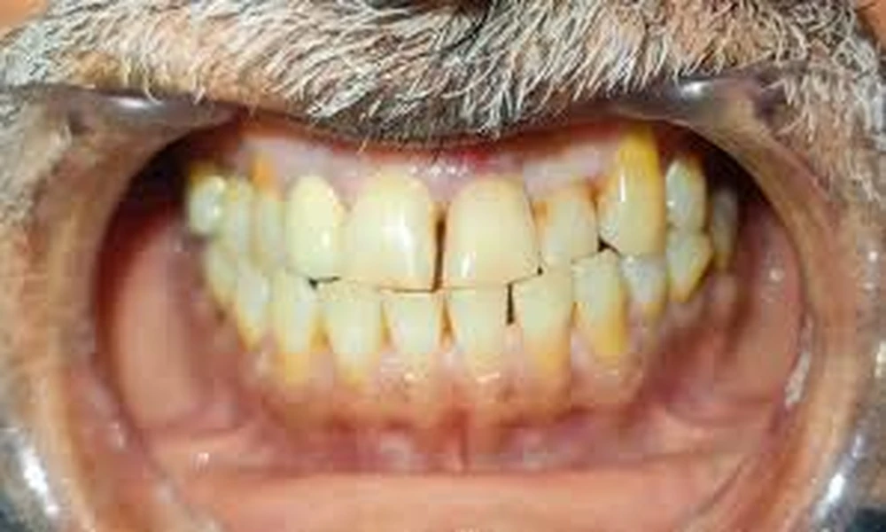 4 Reasons To Have A Loose Dental Veneer Evaluated Before Using A Repair Kit